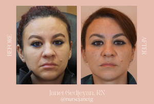 Filler: For Hydration, Volume, and Dimension