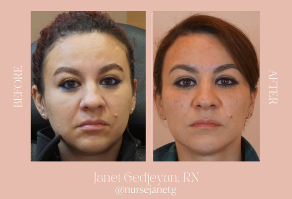 Filler: For Hydration, Volume, and Dimension
