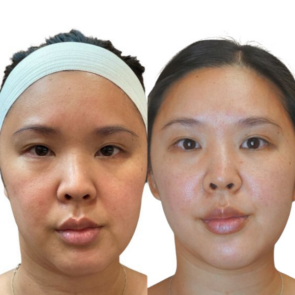 Who is a good candidate for a thread lift?