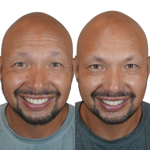How Many Units of Botox Do I Need?