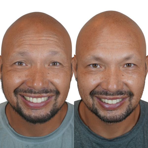 How Many Units of Botox Do I Need?