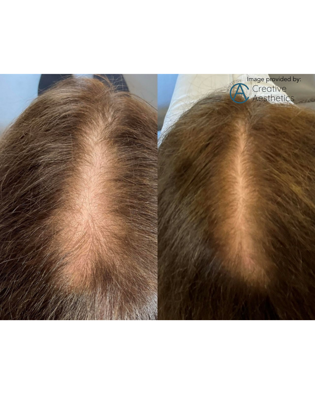 PDGF+ Hair Restoration Series of 3 (reg $4200) + FREE High Frequency Wand