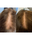 PDGF+ Hair Restoration Series of 3 (reg $4200) + FREE High Frequency Wand