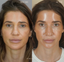Sculptra